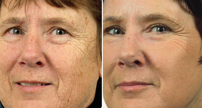 before and after laser facelift woman