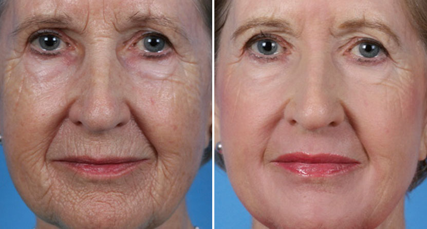 before and after laser facelift sciton