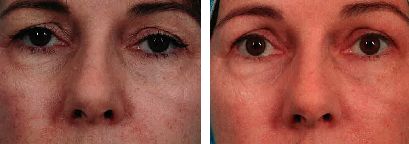 Before and after ThermiEyes treatment.