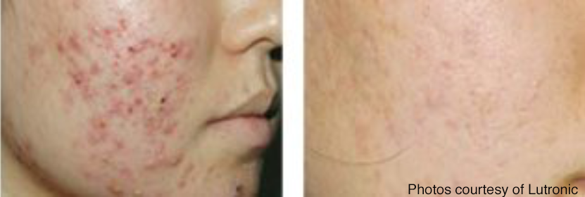 Before and after acne scar removal.