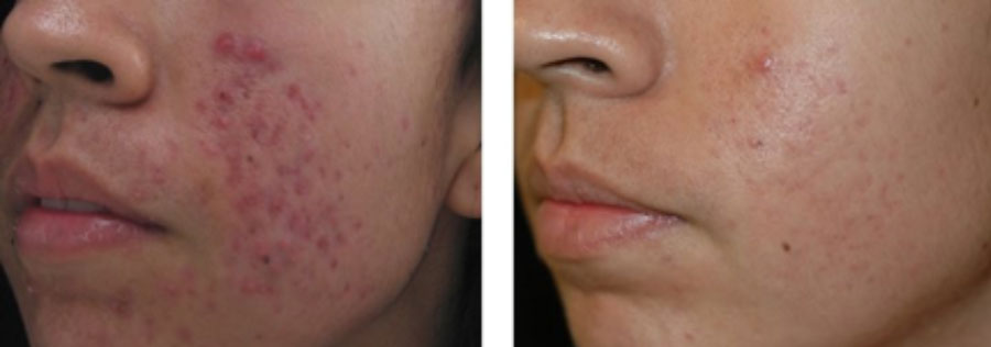 Spectra laser before and after acne treatment.