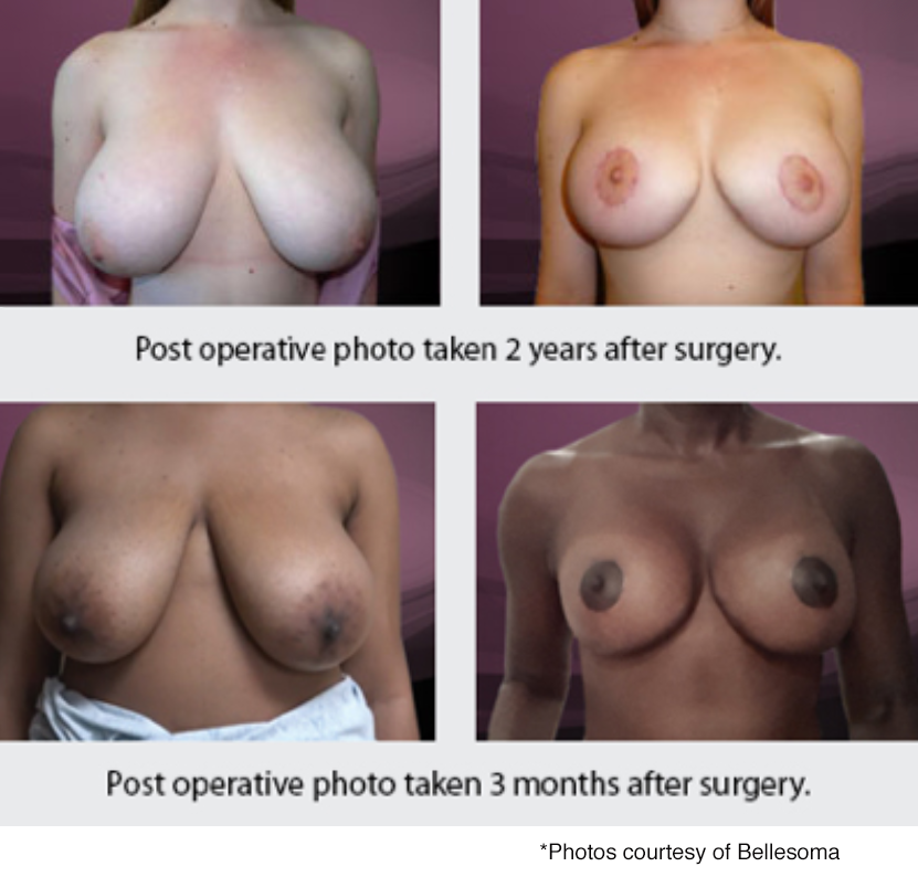 Bellesoma breast reduction before and after