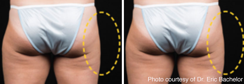CoolSculpting saddlebags before and after.