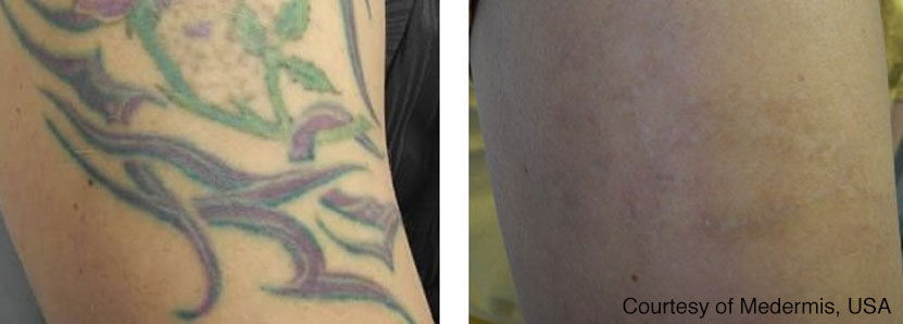 Before and after laser tattoo removal.