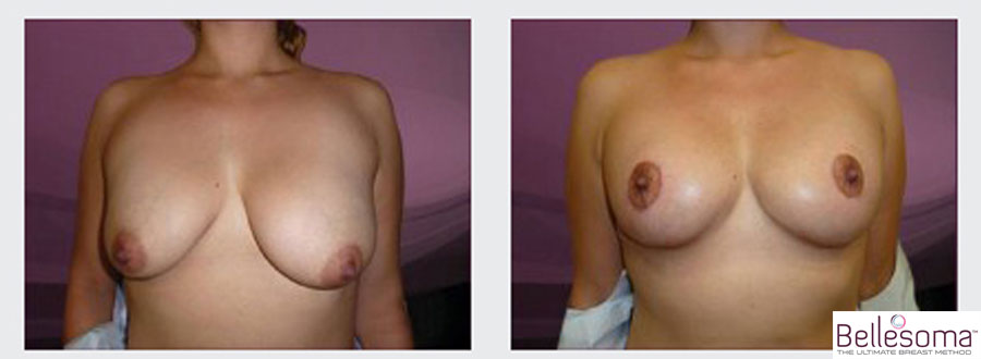 Bellesoma breast lift before and after