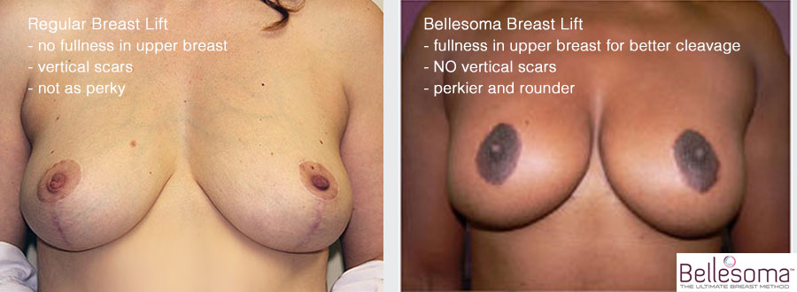 Bellesoma breast lift and traditional breast lift.