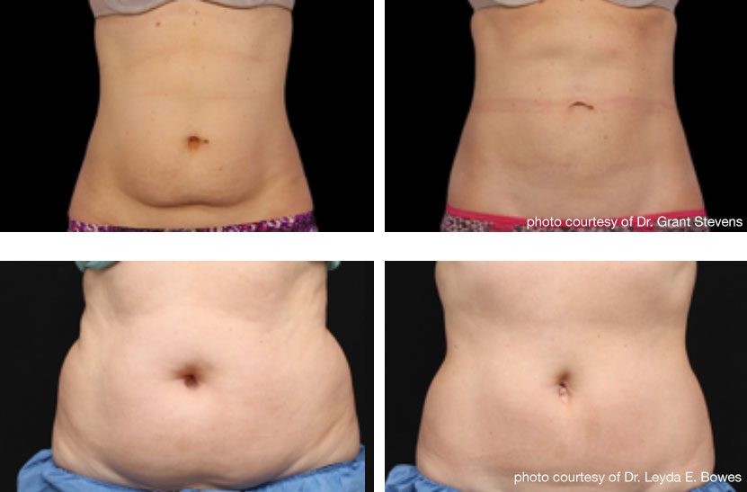 Before and after coolsculpting on the abdomen.