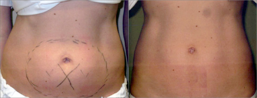 Woman after coolsculpting.
