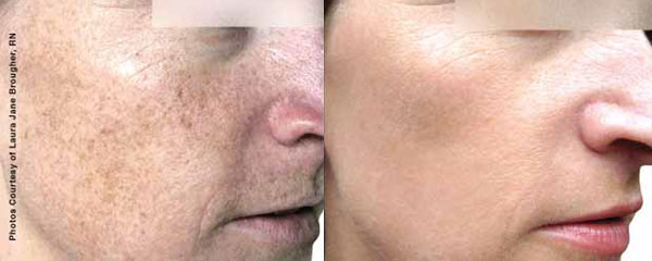 Woman before and after her photofacial rejuvenation.